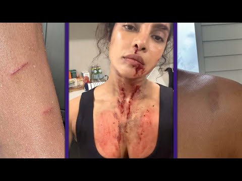 Priyanka Chopra Shows Off REAL BATTLE SCARS While Filming Action Movie