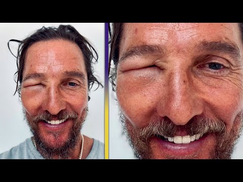 Matthew McConaughey’s Eye SWOLLEN SHUT From Bee Sting!