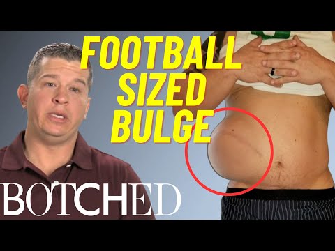 Wesley Looks Like He “Swallowed A Football” FULL TRANSFORMATION | Botched | E!